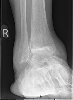 Ankle-Arthritis