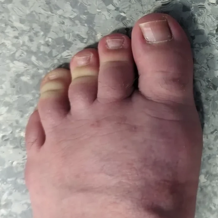 bunion-after-minimally-invasive-surgical-correction-1-874x1024 (2)