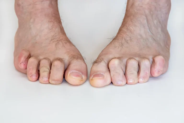 hammer-toes-1024x683