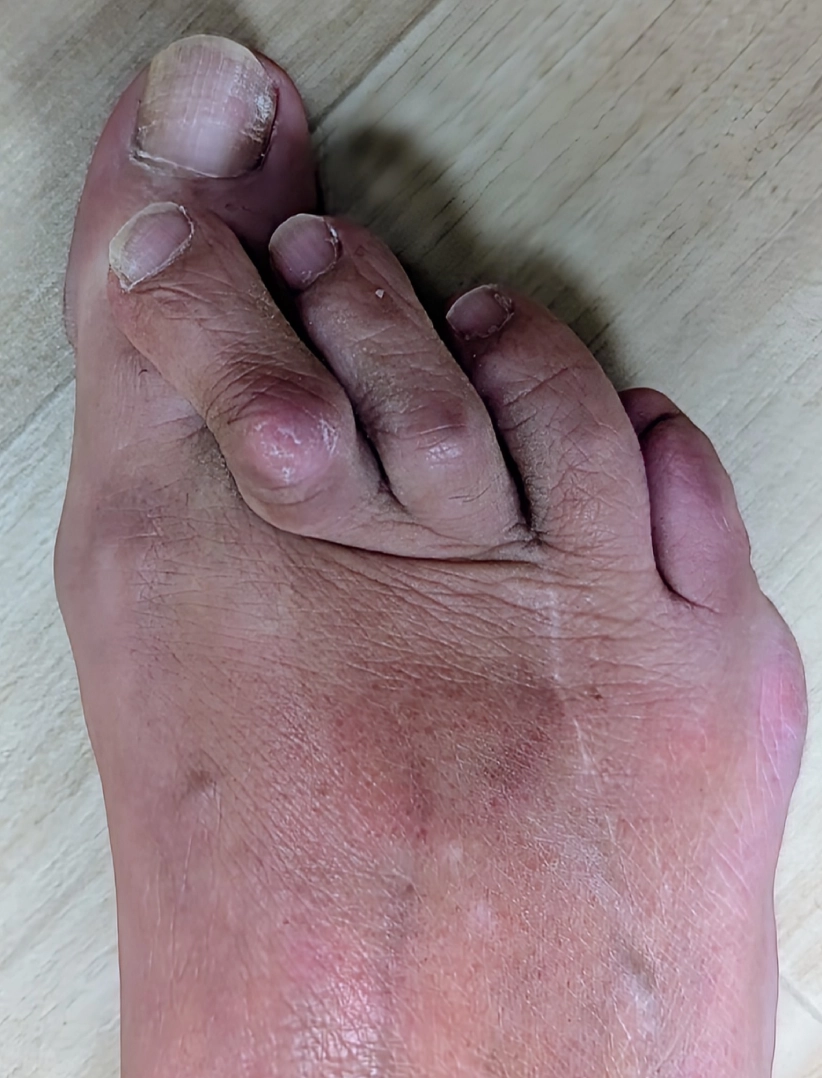 toes before (1) (1) toes before (1) (1)