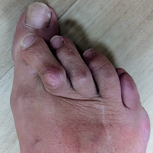 toes-before-1-1 (1) toes-before-1-1 (1)