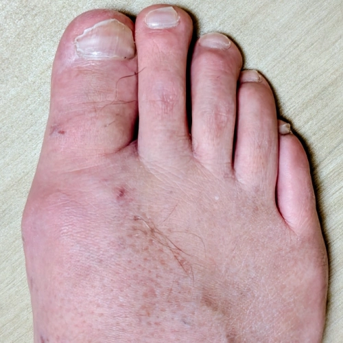 Hammer toes treatment improving alignment and reducing toe joint pain