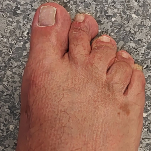 Treatment for a hammer toe to relieve pressure and improve toe movement
