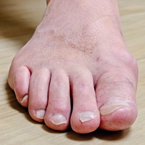 Hammer toes treatment improving alignment and reducing toe joint pain