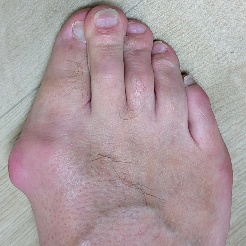 Treatment for hammer toe using advanced orthopedic correction methods