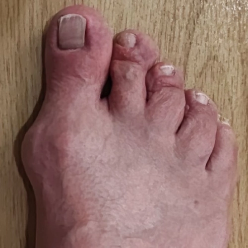 Orthopaedic foot specialist in Cheltenham providing advanced foot pain treatment