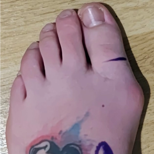 Orthopaedic foot specialist in Cheltenham providing advanced foot pain treatment